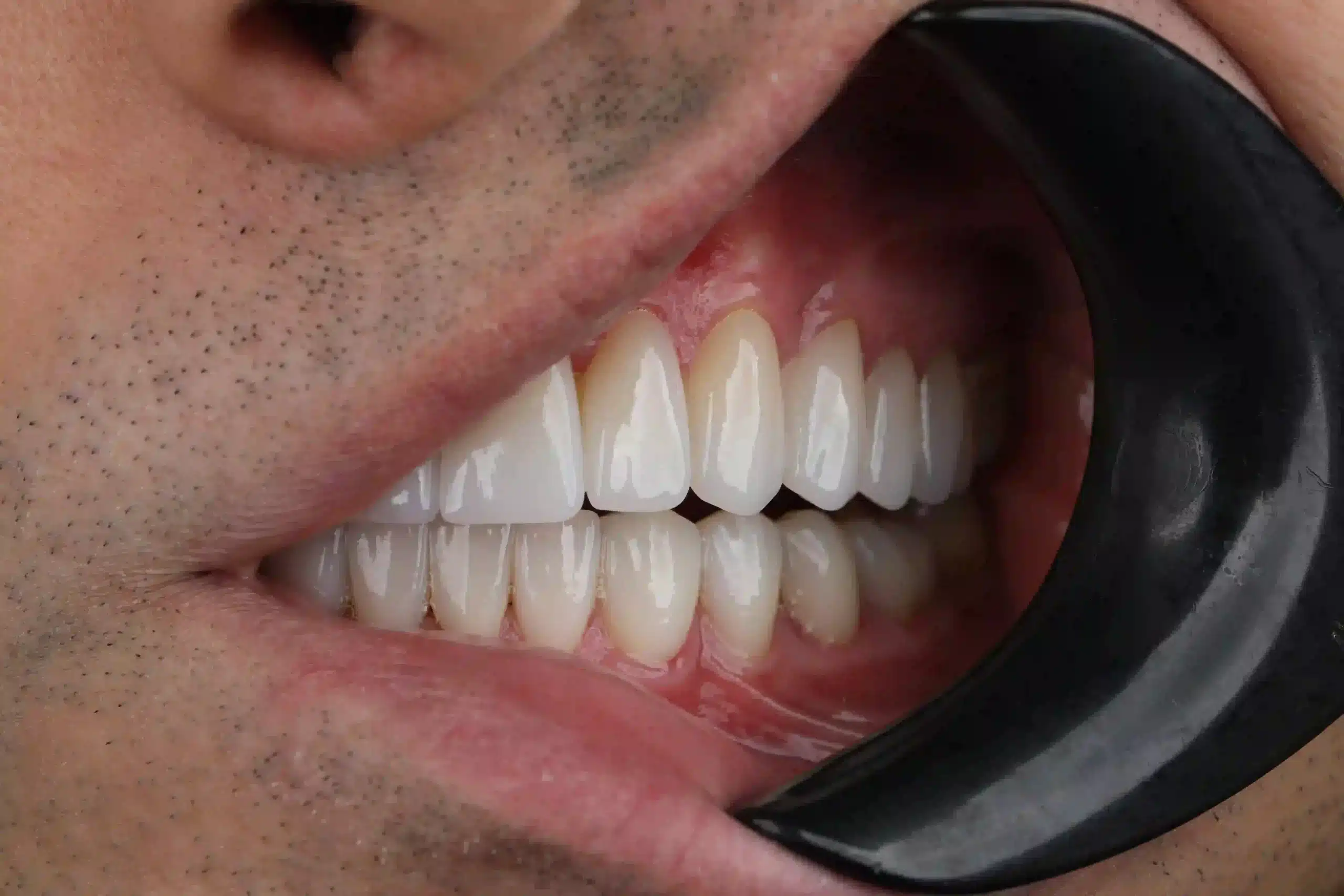 new teeth turkey before after
