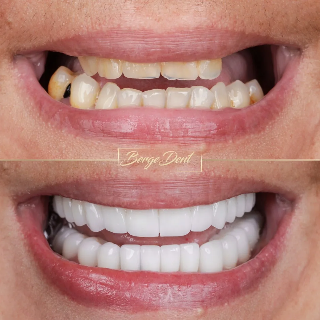 dental implants before after turkey