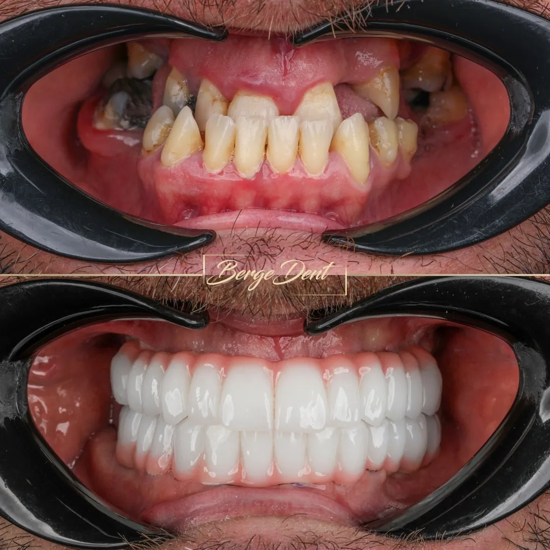 emax veneers before after istanbul