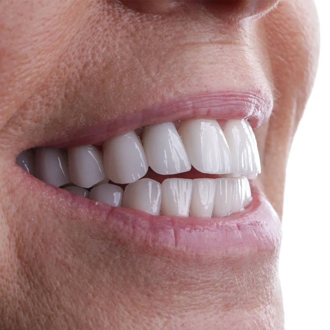 teeth whitening before after turkey