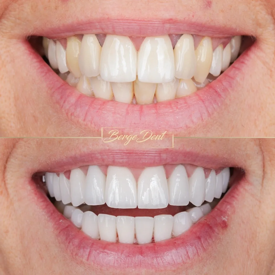 turkey teeth transformation result