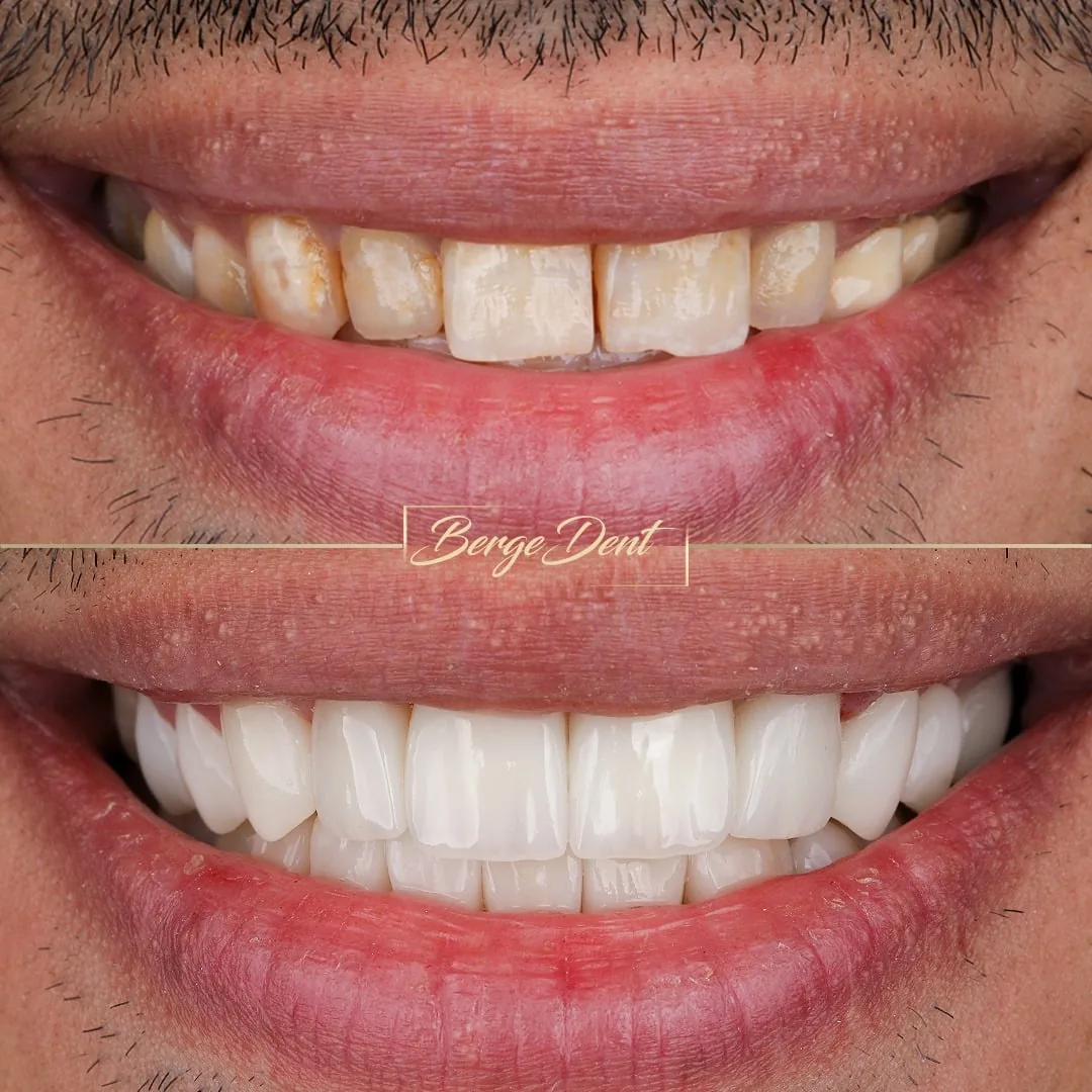 smile makeover istanbul bergedent