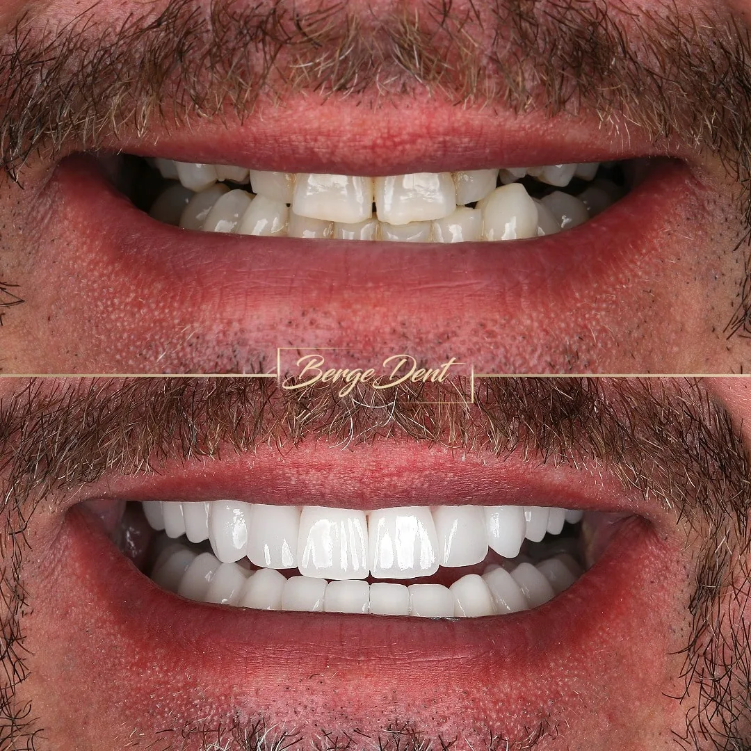 teeth transformation turkey before after