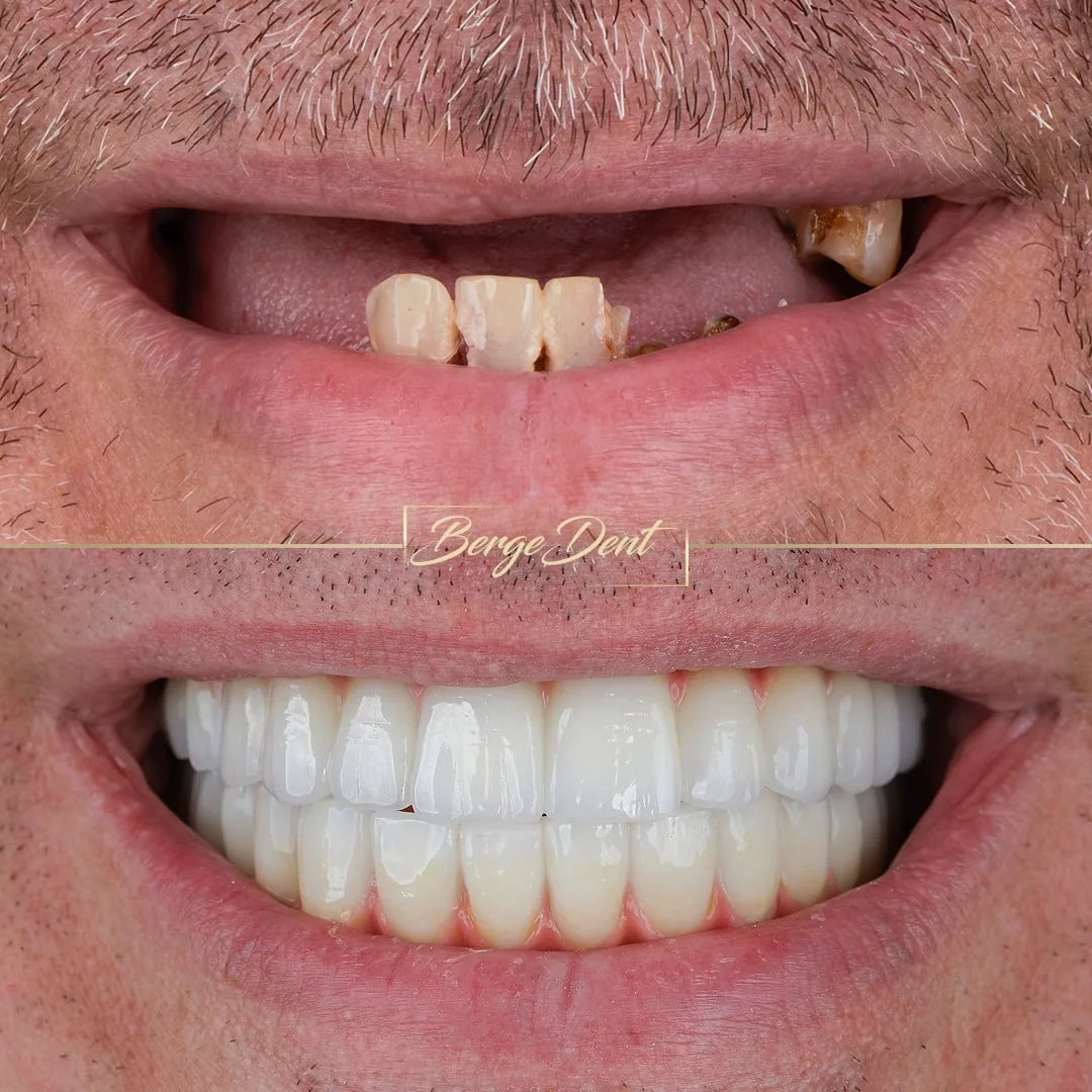 before after dental veneers turkey bergedent