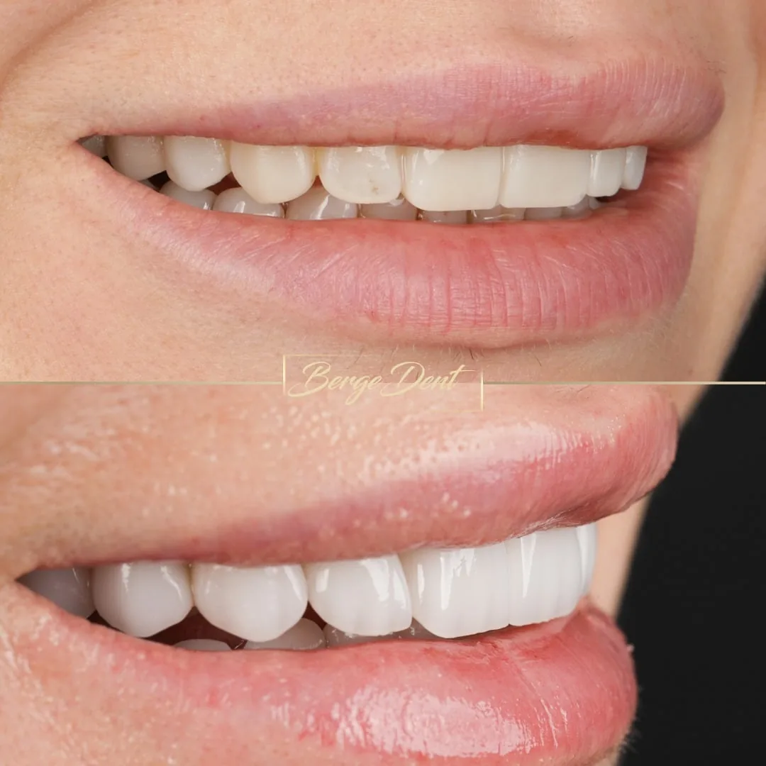 implant before after turkey bergedent