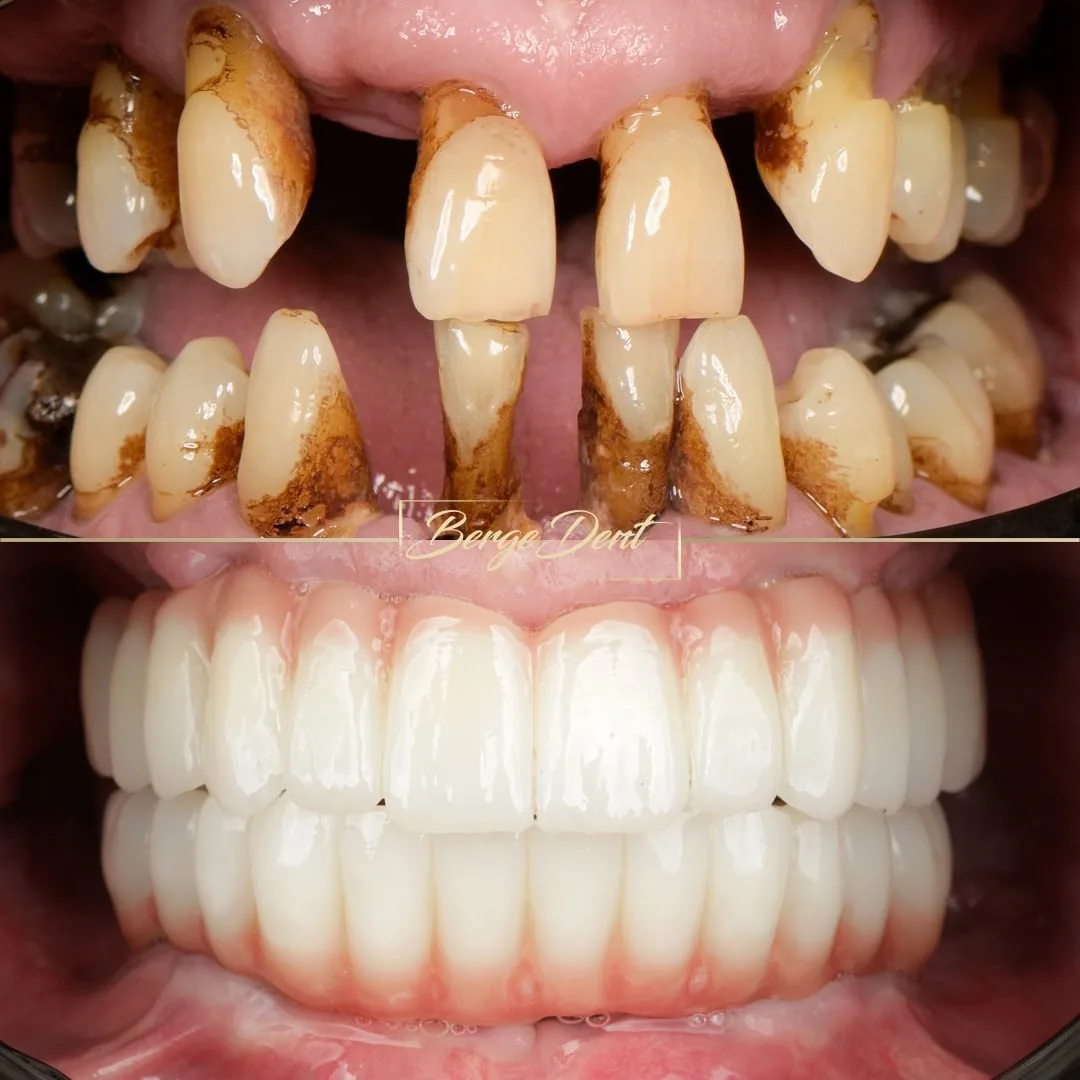 complete dental restoration turkey