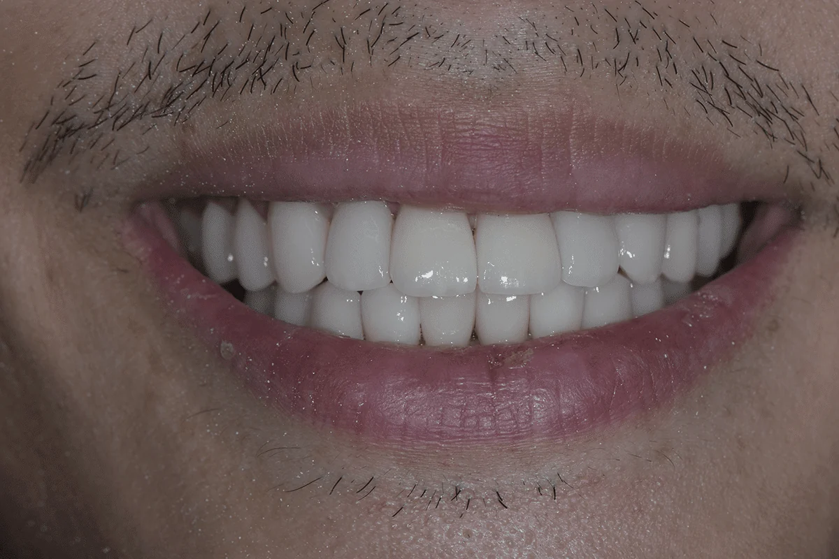 veneers before after bergedent
