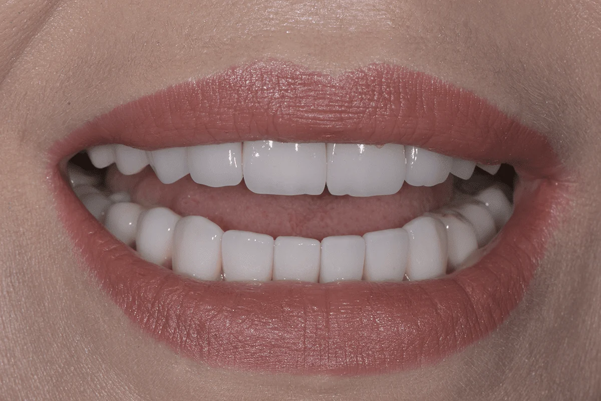 smile makeover before after istanbul