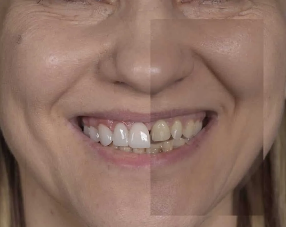 before after dental work turkey bergedent