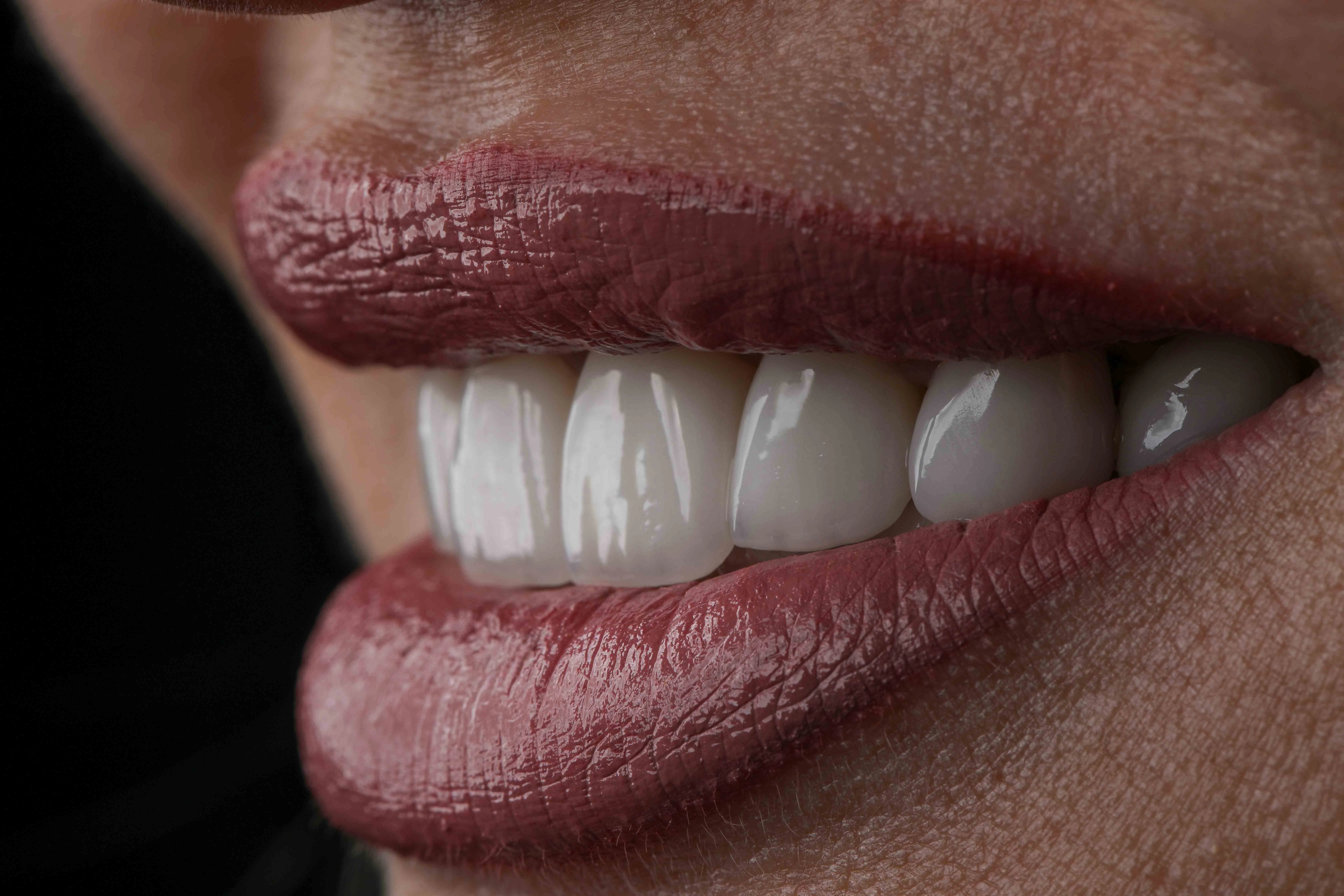 E-max veneers Turkey