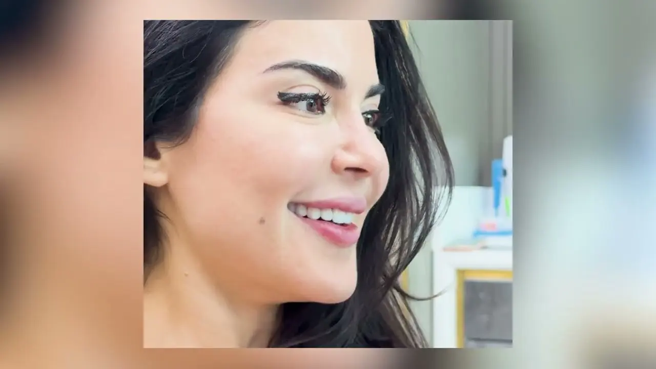 E.max Laminate Veneers