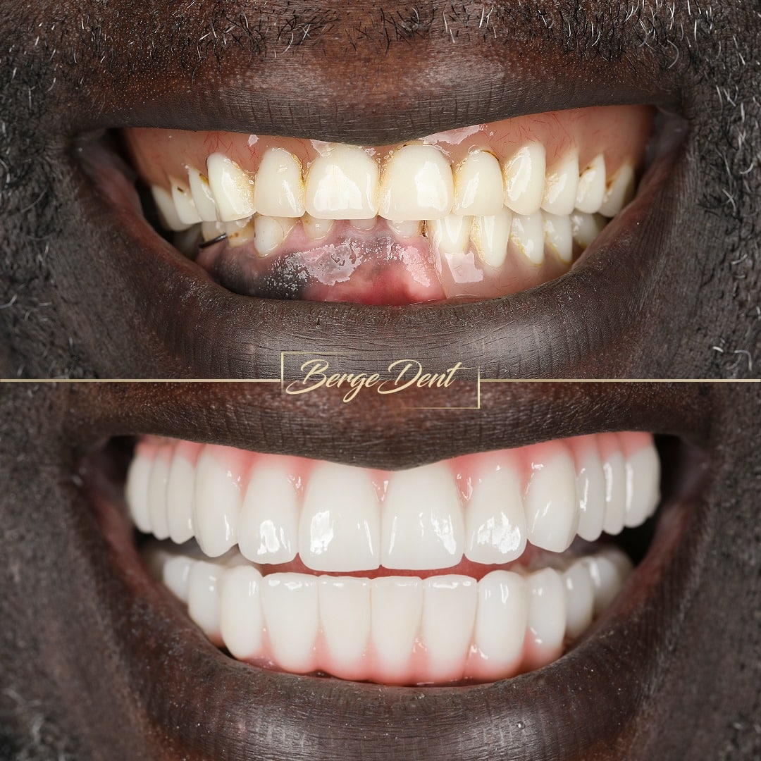 After Zirconia Crowns Bergedent Istanbul