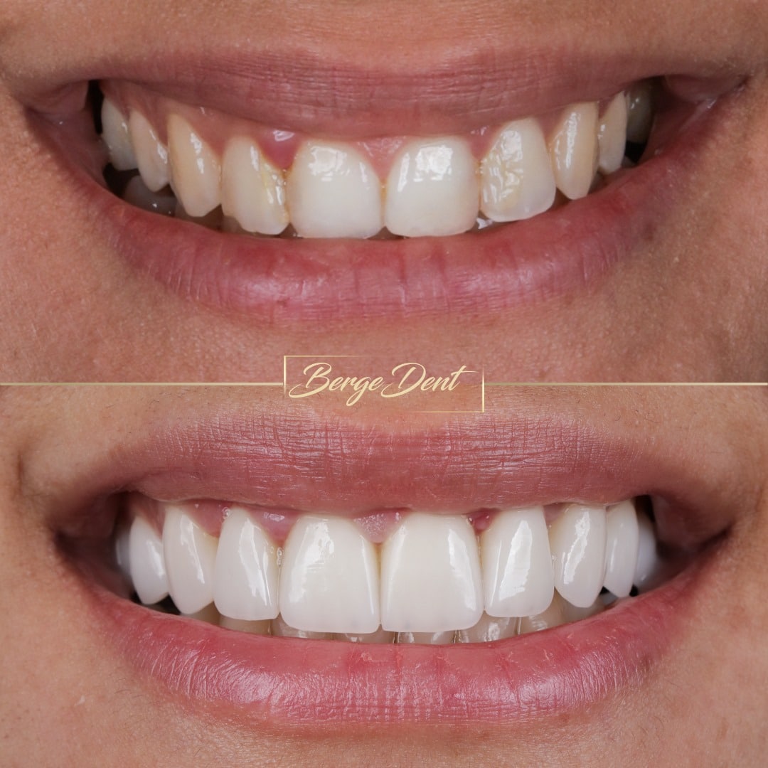 Before Hollywood Smile Bergedent Istanbul
