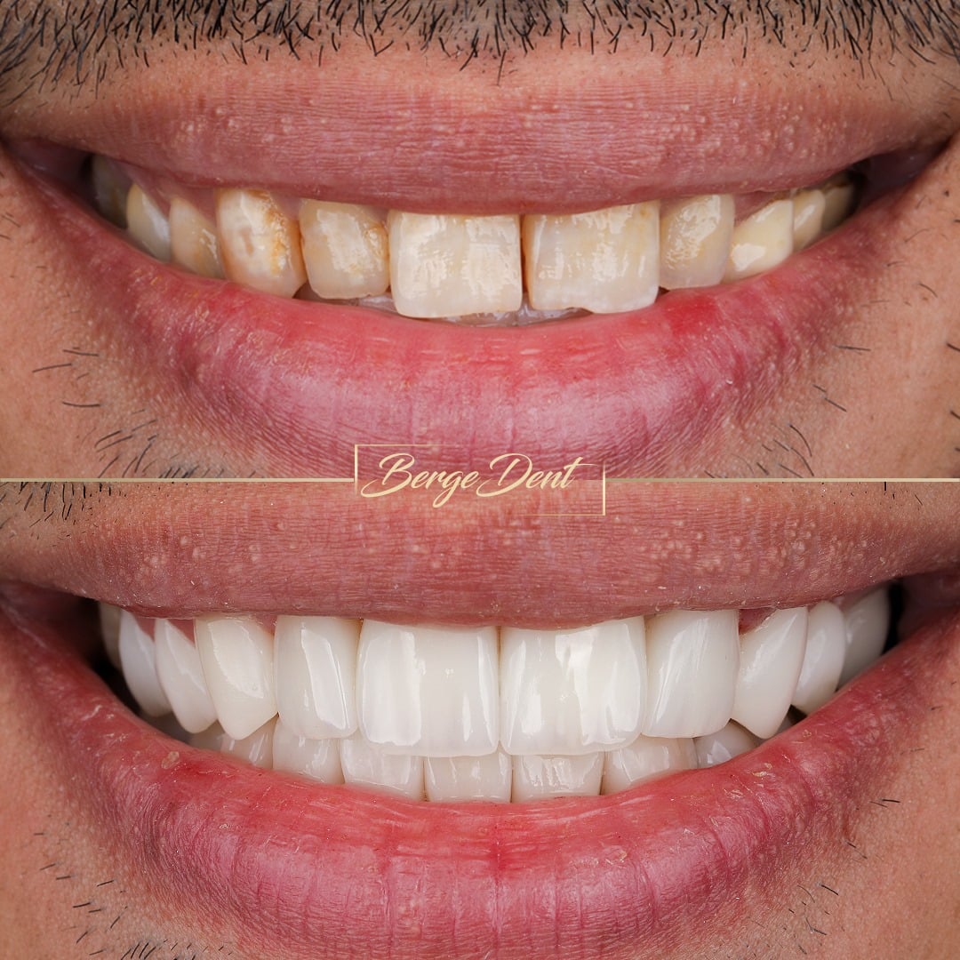 Before Dental Implants Bergedent Istanbul