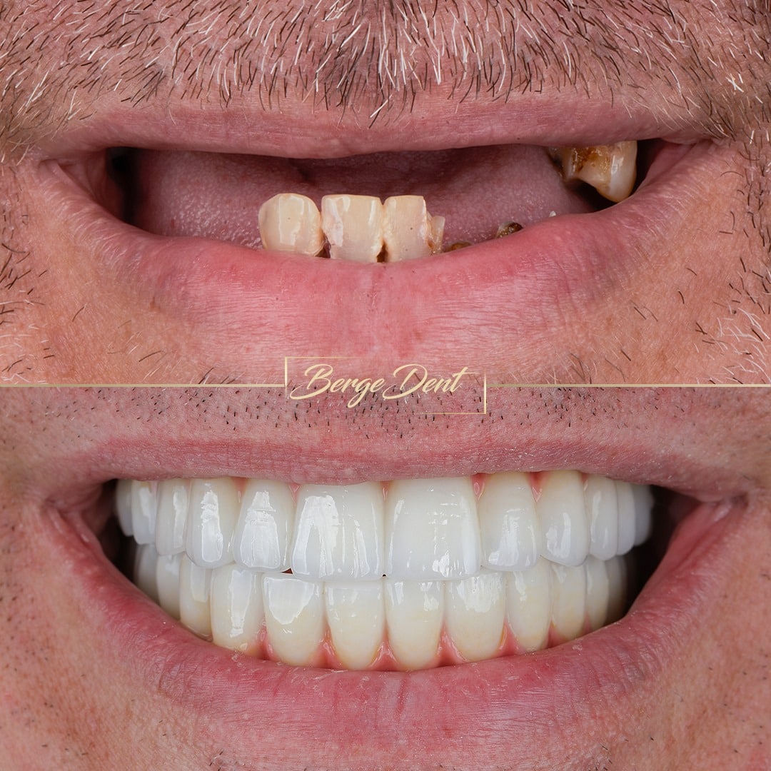 After Dental Implants Bergedent Istanbul