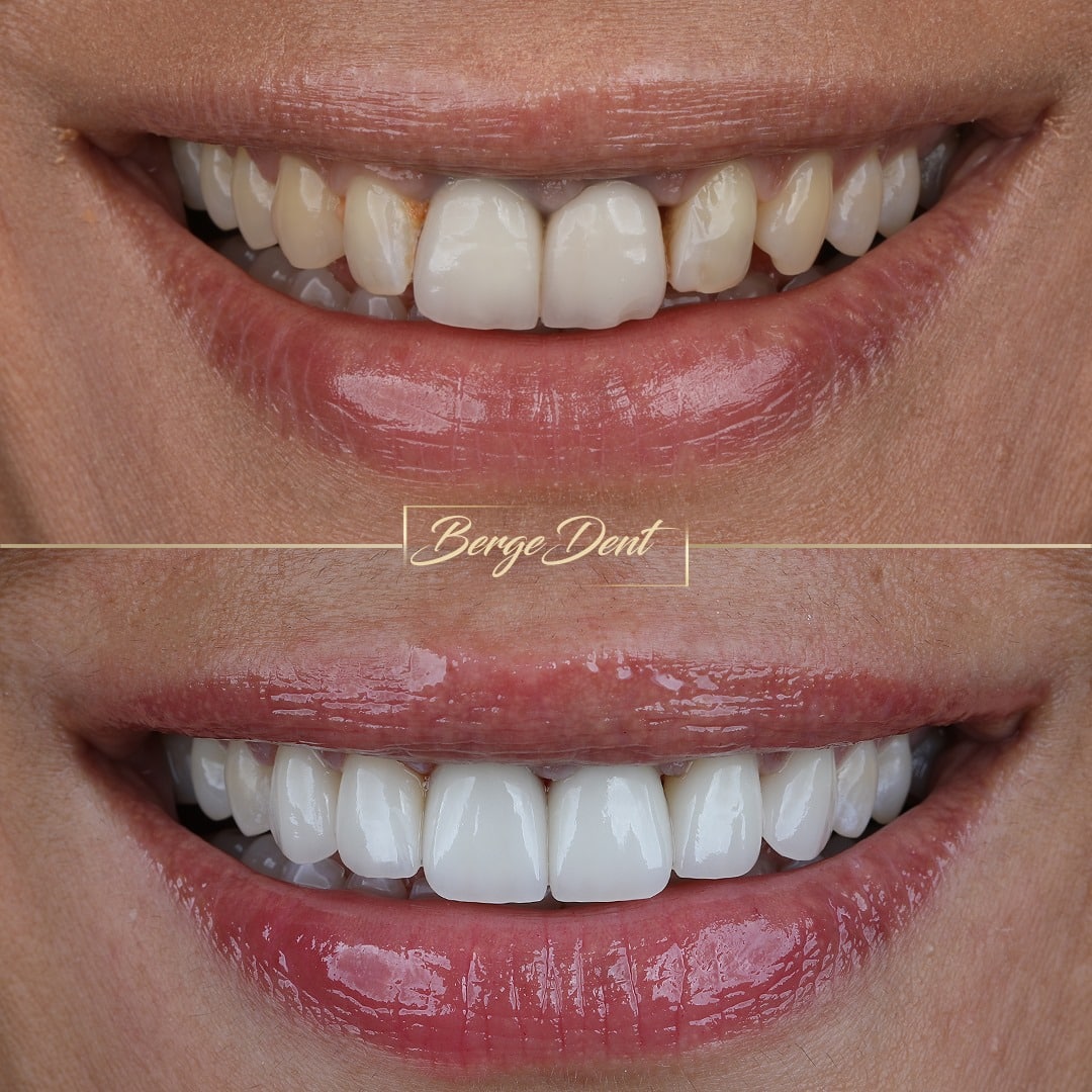After Hollywood Smile Bergedent Istanbul
